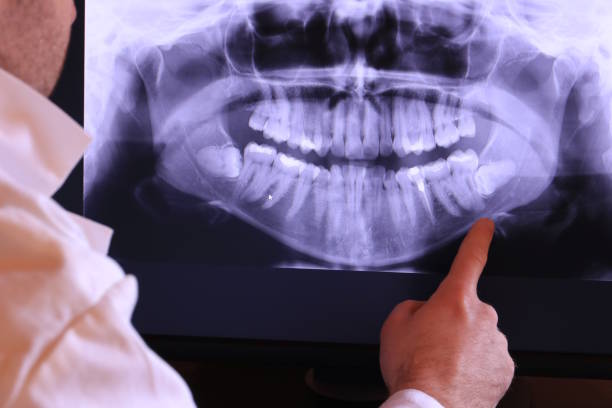 Best Emergency Dentist for Lost Fillings or Crowns in Dexter, MI